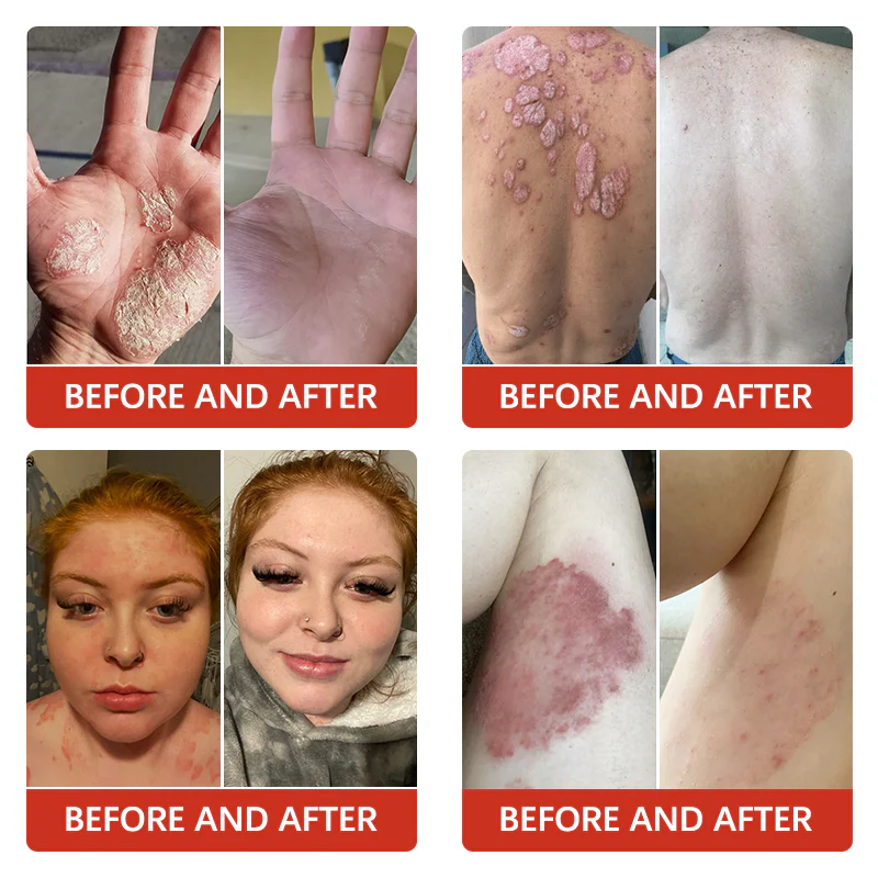 Furzero™ PsoriaKing Psoriasis Antibacterial Treatment Cream