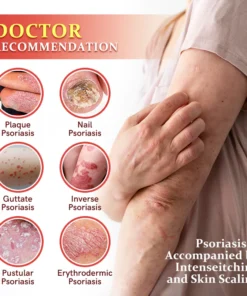 Furzero™ PsoriaKing Psoriasis Antibacterial Treatment Cream