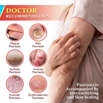 Furzero™ PsoriaKing Psoriasis Antibacterial Treatment Cream