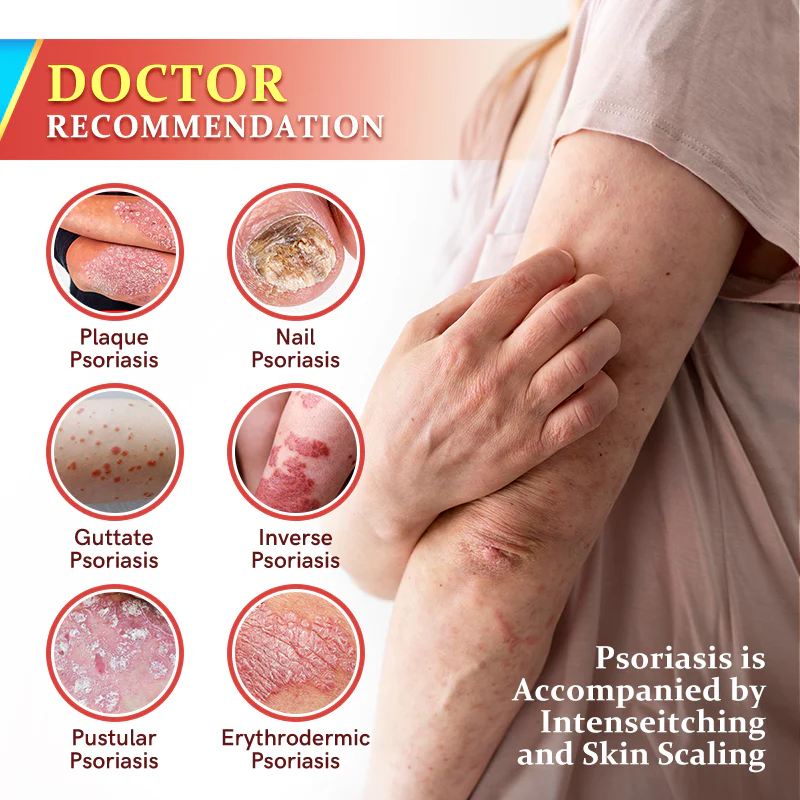 Furzero™ PsoriaKing Psoriasis Antibacterial Treatment Cream