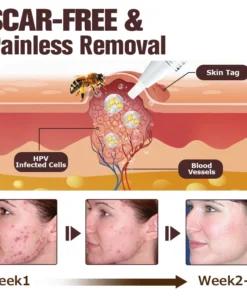 Furzero™ TagFree And Moles Remover