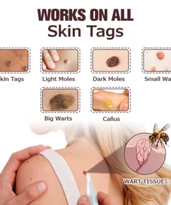 Furzero™ TagFree And Moles Remover