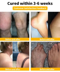 Furzero™ 𝐁𝐞𝐞 𝐕𝐞𝐧𝐨𝐦 𝐀𝐝𝐯𝐚𝐧𝐜𝐞𝐝 𝐉𝐨𝐢𝐧𝐭 𝐚𝐧𝐝 𝐁𝐨𝐧𝐞 𝐓𝐡𝐞𝐫𝐚𝐩𝐲 𝐂𝐫𝐞𝐚𝐦