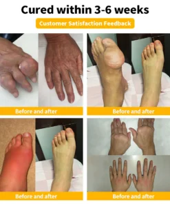 Furzero™ 𝐁𝐞𝐞 𝐕𝐞𝐧𝐨𝐦 𝐀𝐝𝐯𝐚𝐧𝐜𝐞𝐝 𝐉𝐨𝐢𝐧𝐭 𝐚𝐧𝐝 𝐁𝐨𝐧𝐞 𝐓𝐡𝐞𝐫𝐚𝐩𝐲 𝐂𝐫𝐞𝐚𝐦