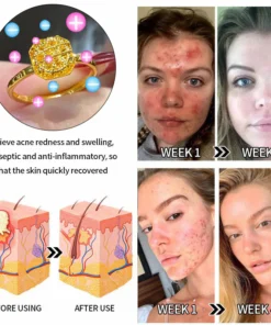 Futusly™ Lymphatische Magnettherapie Goldring