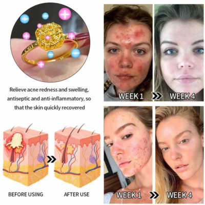 Futusly™ Lymphatische Magnettherapie Goldring