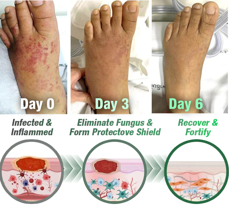 GFOUK™ Tineasil Athlete's Foot Crocodile Oil Treatment Spray 