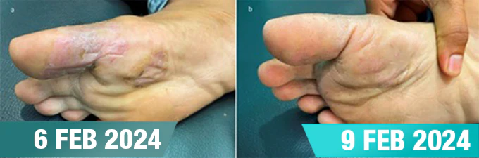 GFOUK™ Tineasil Athlete's Foot Crocodile Oil Treatment Spray 