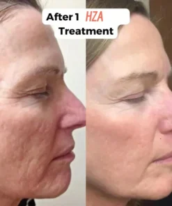 HZA™ Micro Infusion System