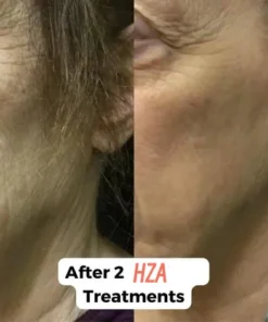 HZA™ Micro Infusion System