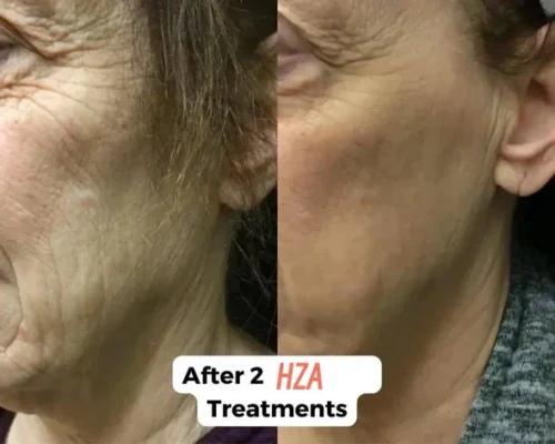 HZA™ Micro Infusion System