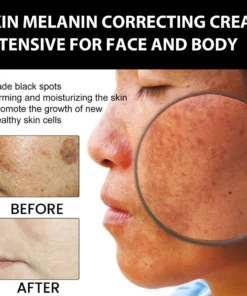 Hudros® Acanthosis Nigricans Therapy