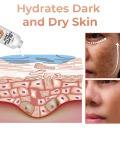 Hudros® Acanthosis Nigricans Therapy