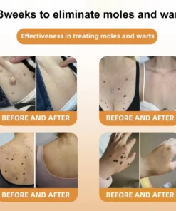 LOVILDS™ Bee Venom Mole and Wart Treatment Cream