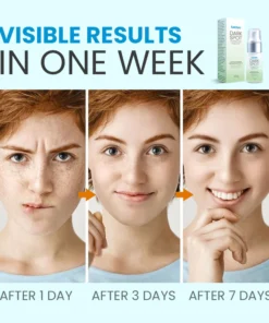 LanClare™ Triple-Active Brightening Dark Spot Corrector Remover