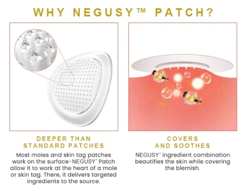 NEGUSY™ Bee Venom Wart & Mole MicroDart Patch
