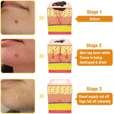 NEGUSY™ Bee Venom Wart & Mole MicroDart Patch