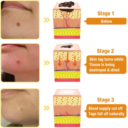 NEGUSY™ Bee Venom Wart & Mole MicroDart Patch