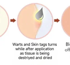 Negsuy™ Bienengift Mole & Warze Behandlung Creme