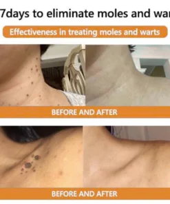 Negsuy™ Bienengift Mole & Warze Behandlung Creme