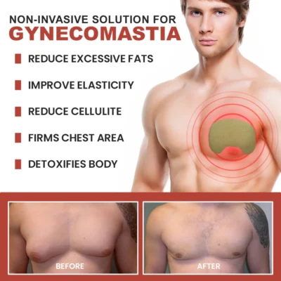Nurbini™ Gynecomastia & Cellulite Reduction Patches