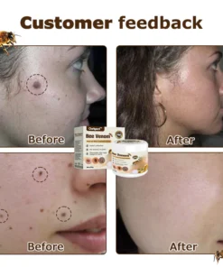 Ourlyard™ Bee Venom Mole and Wart Treatment Cream