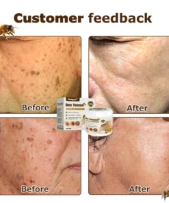 Ourlyard™ Bee Venom Mole and Wart Treatment Cream