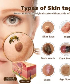 Ourlyard™ Bee Venom Mole and Wart Treatment Cream