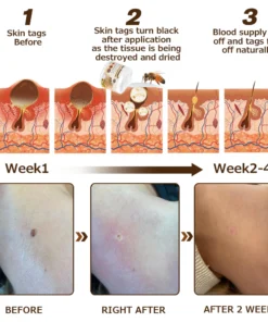 Ourlyard™ Bee Venom Mole and Wart Treatment Cream