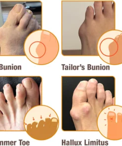 Oveallgo™ HalluxCare Bee Venom Treatment Cream