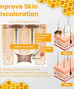 Oveallgo™ Vitiligo Rescue Bee Venom Care Cream