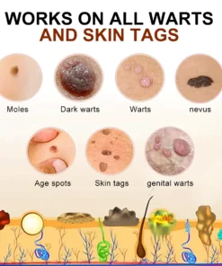 SEAGRIL™ Bee Venom Mole and Wart Treatment Cream