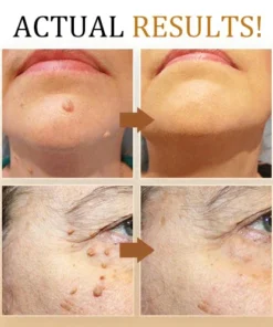 SEAGRIL™ Bee Venom Mole and Wart Treatment Cream