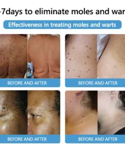 SEAGRIL™ Bee Venom Mole and Wart Treatment Cream