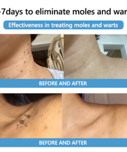 SEAGRIL™ Bee Venom Mole and Wart Treatment Cream