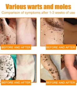 SEAGRIL™ Bee Venom Wart & Tag Removal Cream