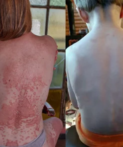 SEAGRIL™ Bee Venom Wart & Tag Removal Cream