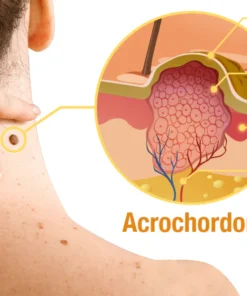 SEAGRIL™ Bee Venom Wart & Tag Removal Cream