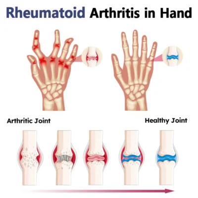 Seurico™ Bee Venom Joint and Bone Therapy Advanced Cream