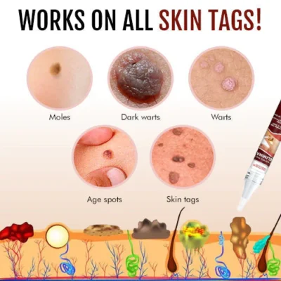 Seurico™ Bee Venom Mole Wart Removal Pen