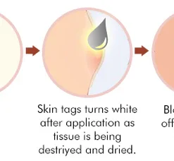 Seurico™ Bee Venom Mole Wart Removal Pen