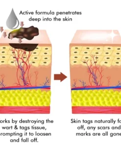 Seurico™ Bee Venom Mole Wart Removal Pen