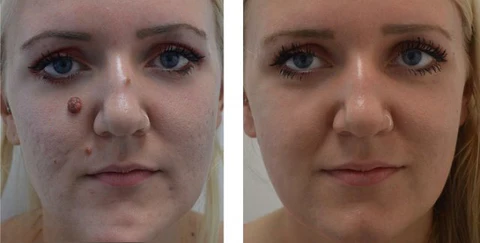 Toclve™ BEE VENOM Wart & Mole Removal Cream