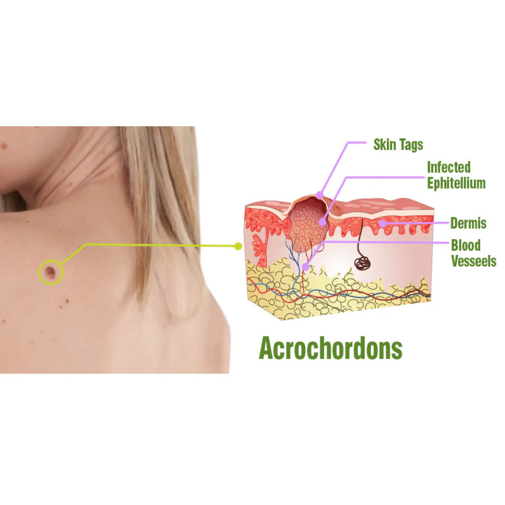 flysmus™ TagOff Comfrey Herbal Treatment Serum