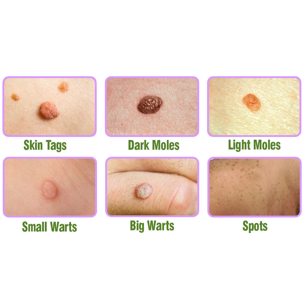 flysmus™ TagOff Comfrey Herbal Treatment Serum