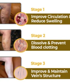 flysmus™ Varico-X Vein Dredge Bee Venom Spray