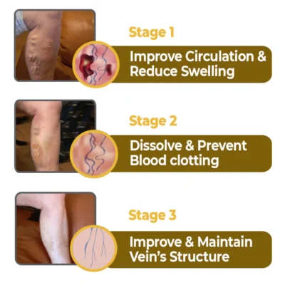 flysmus™ Varico-X Vein Dredge Bee Venom Spray