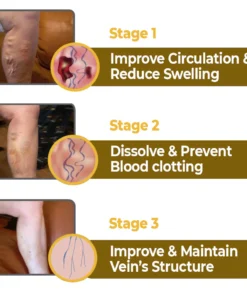 flysmus™ VaricoX Vein Dredge Bee Venom Spray