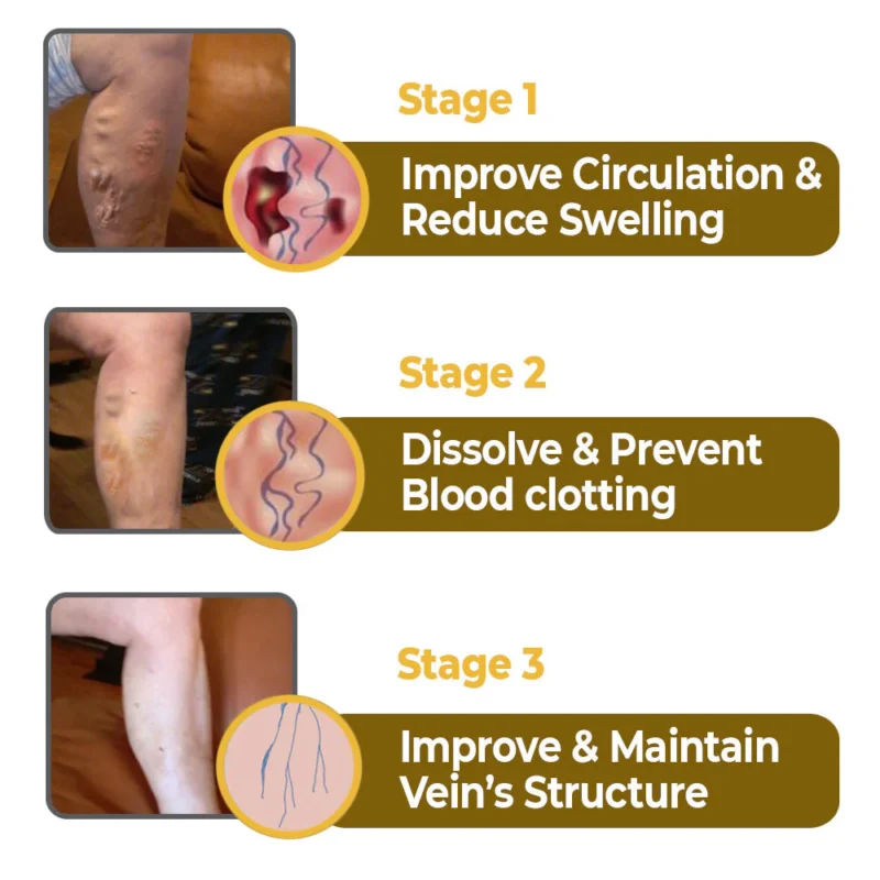 flysmus™ VaricoX Vein Dredge Bee Venom Spray