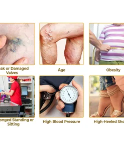 flysmus™ VaricoX Vein Dredge Bee Venom Spray